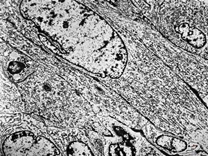 F,61y. | leiomyosarcoma - axilla F,61y. | leiomyosarcoma - axilla